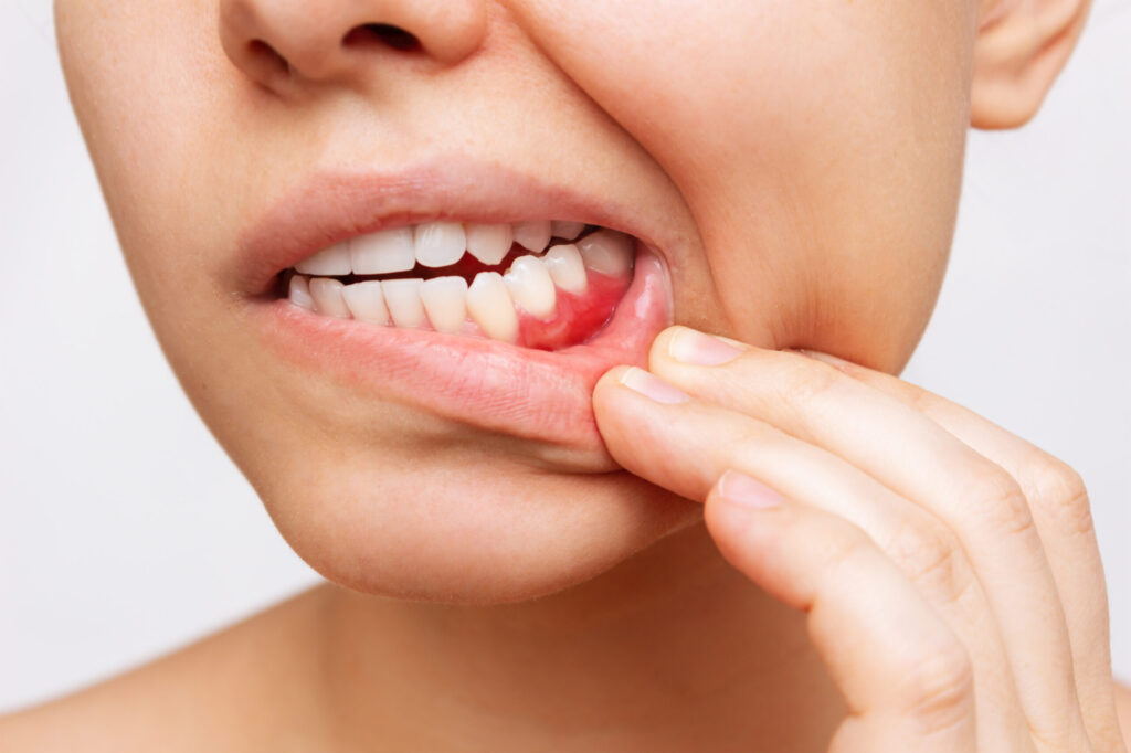 Our team at Edmonds Dental Care explain the signs of gum disease that you need to look out for.